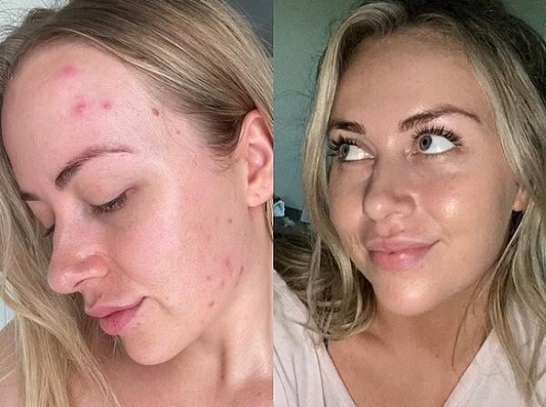 بعدما معاناتها لسنوات طويلة.. تتخلص من حب الشباب بتغيرات على نظام العناية ببشرتها